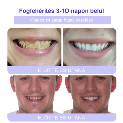 Cvreoz® Fogápoló Ásványi Por — 🦷Vége a lüktető fogfájásnak, érzékeny fogaknak és gyenge zománcnak, már az első használatok után (FDI ajánlott)