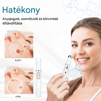 ✨Bikenda® non-invazív anyajegy- és szemölcseltávolító lézertoll💎