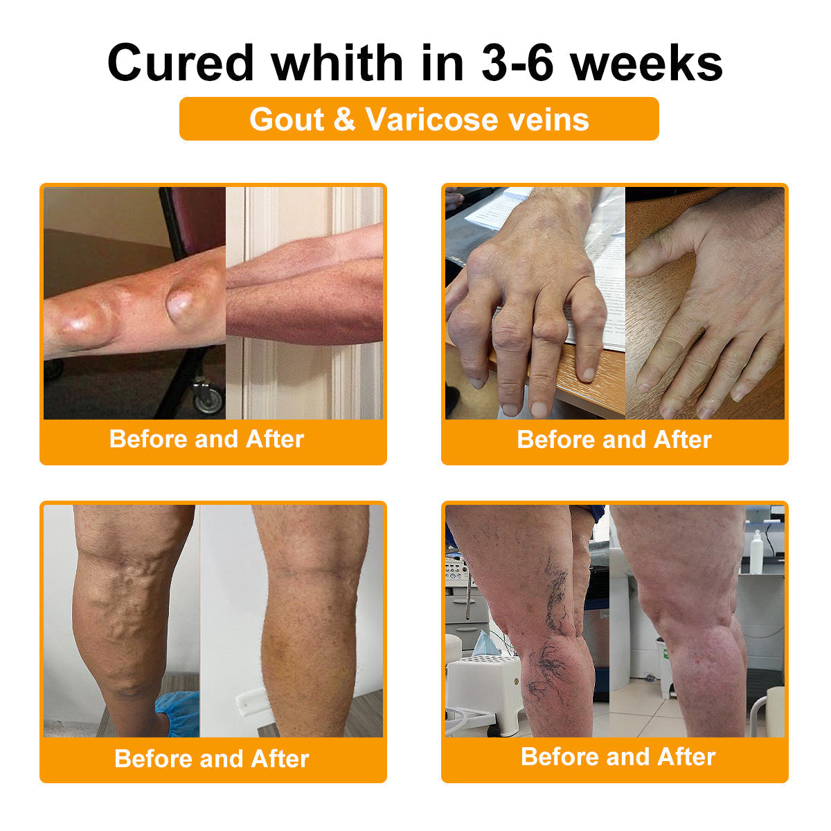 💎TLOPA® Botulinum Toxin és Méhméreg Fájdalomcsillapító Csontgyógyító Krém🐝 🔥(Kifejezetten időseknek & ortopéd szakorvosok ajánlásával)🦴