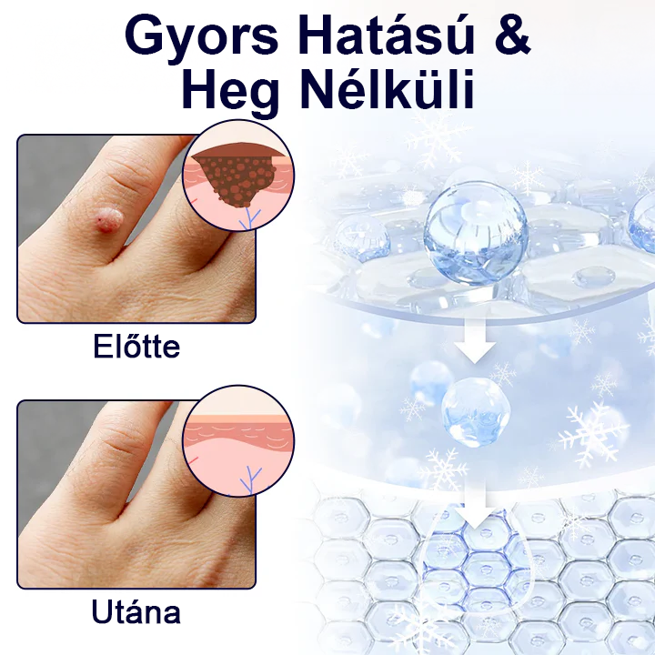 🎁Timilk® WartErase Fagyasztó Kriospray