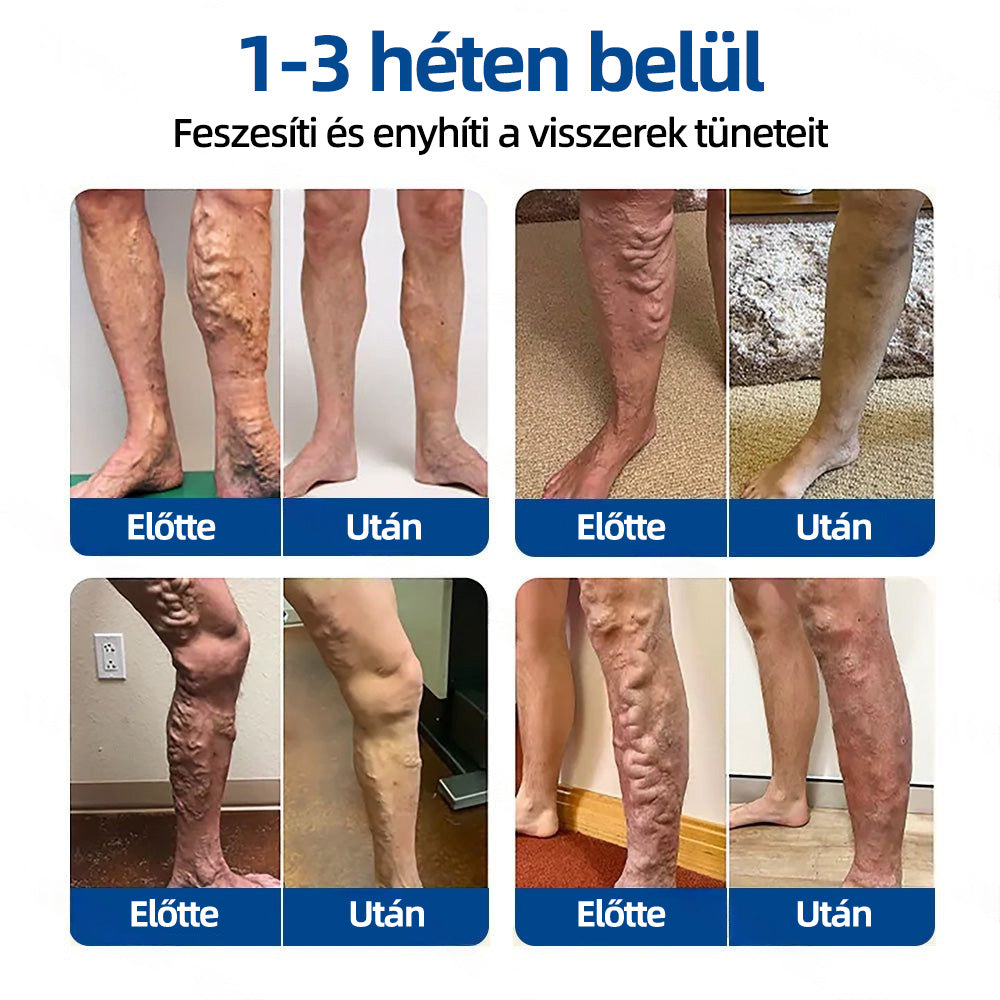 Healrize® Vénacélpont mikrotűs tapasz⚡Azonnali enyhülés hosszú távú eredmények🇭🇺