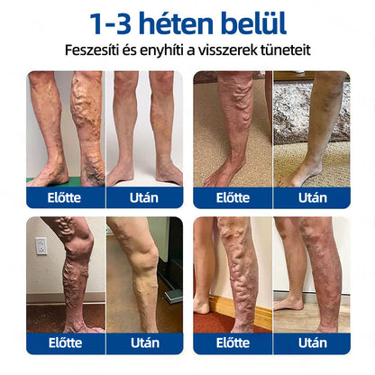 Healrize® Vénacélpont mikrotűs tapasz⚡Azonnali enyhülés hosszú távú eredmények🇭🇺