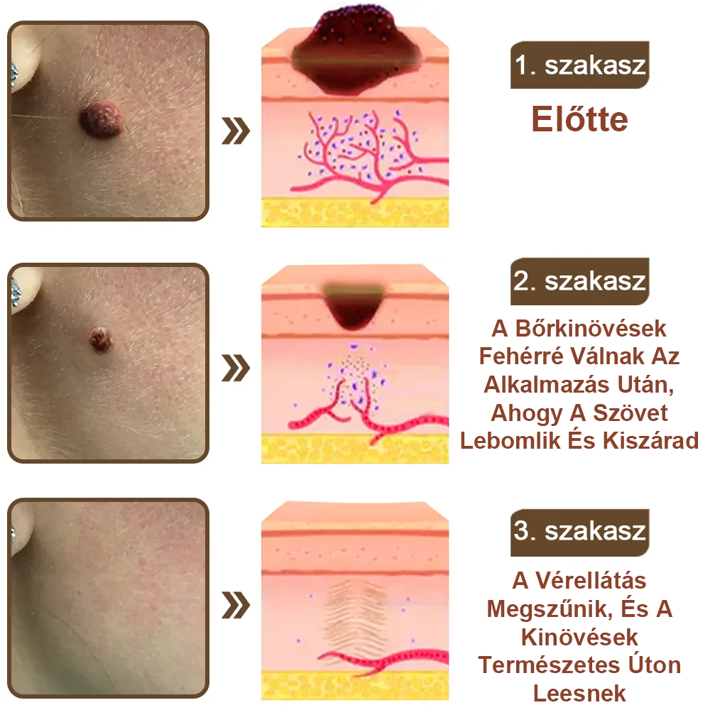 Pureluxo® Fekete Rizses Bőrregeneráló Krém 👨‍⚕️ (Szemölcsök, bőrkinövések, foltok és hiperpigmentáció kezelésére)